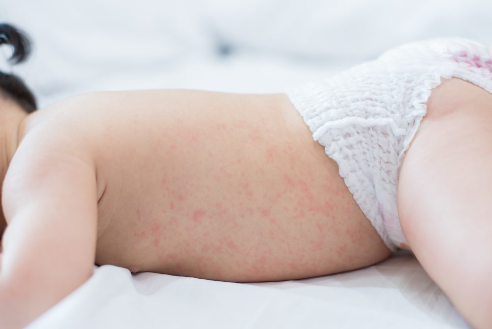 baby heat rash on skin, prickly heat on baby